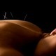 Acupuntura, Moxibustión, Ventosas, Aurículoterapia